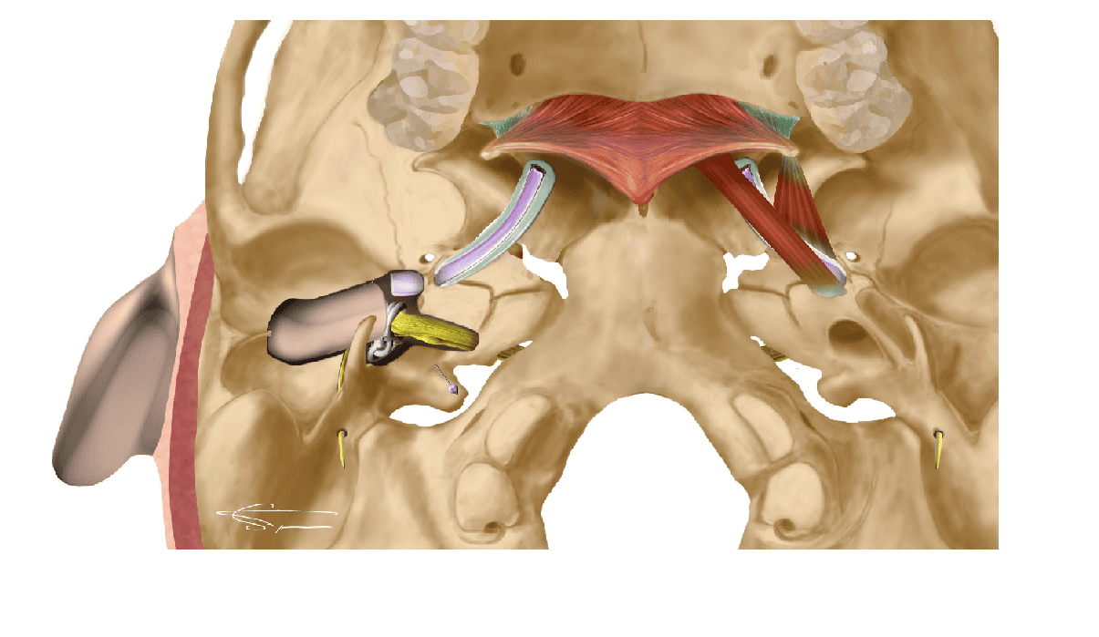 ECG5-La-configuration-médicale-des-prothèses-auditives-dans-le-canal-auriculaire-pour-la-puissance-et-la-précision.