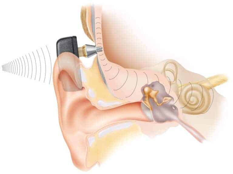 La Baha 6 Max Un Appareil Auditif Conduction Osseuse Compact La Baha 6 Max Un Appareil Auditif Conduction Osseuse Compact